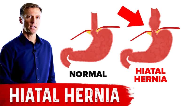 Hiatal Hernia: The Best Home